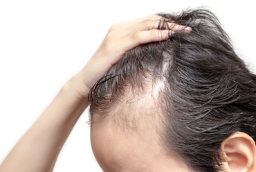 Alopecia Areata