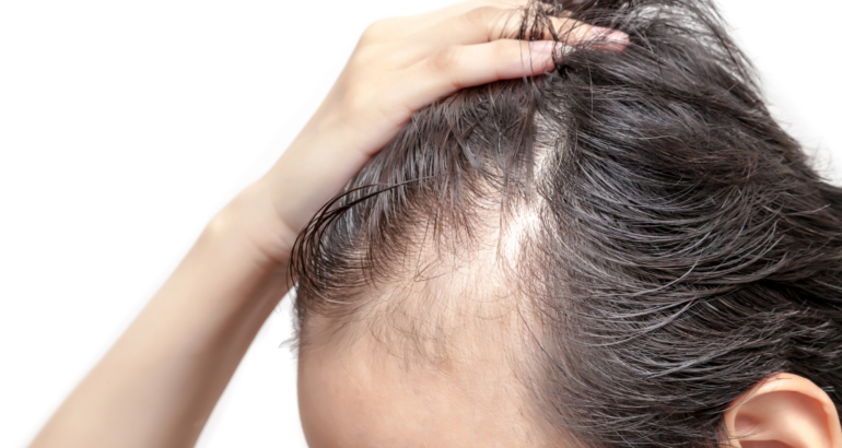 Alopecia Areata